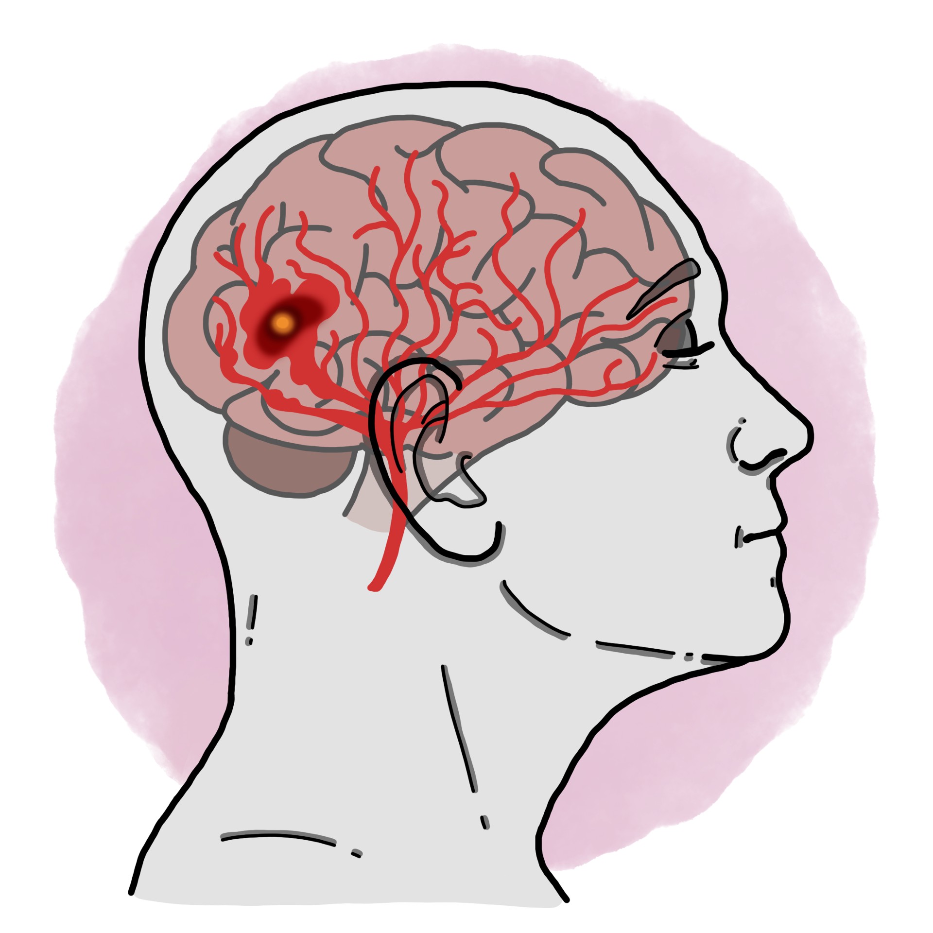 Stroke - Posterior cerebral artery