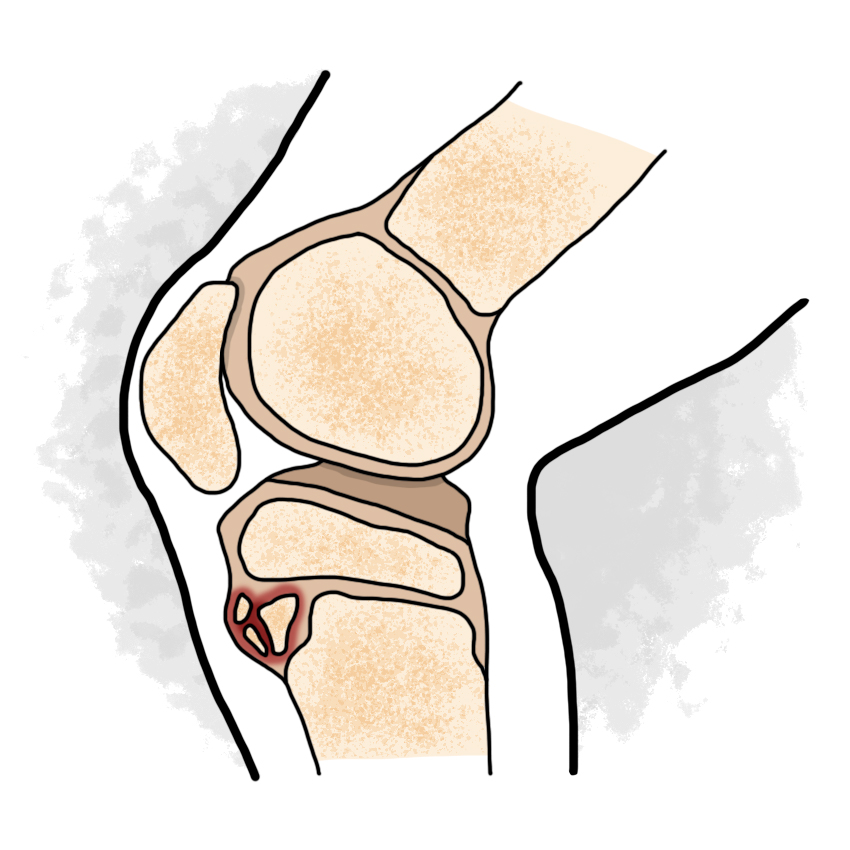 Osteochondritis - Osteochondritis Dissecans disease