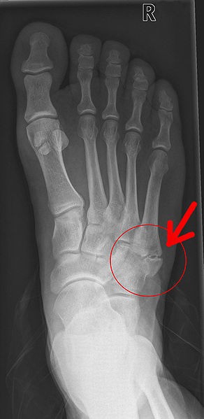 Foot fracture - Fracture of the foot bones
