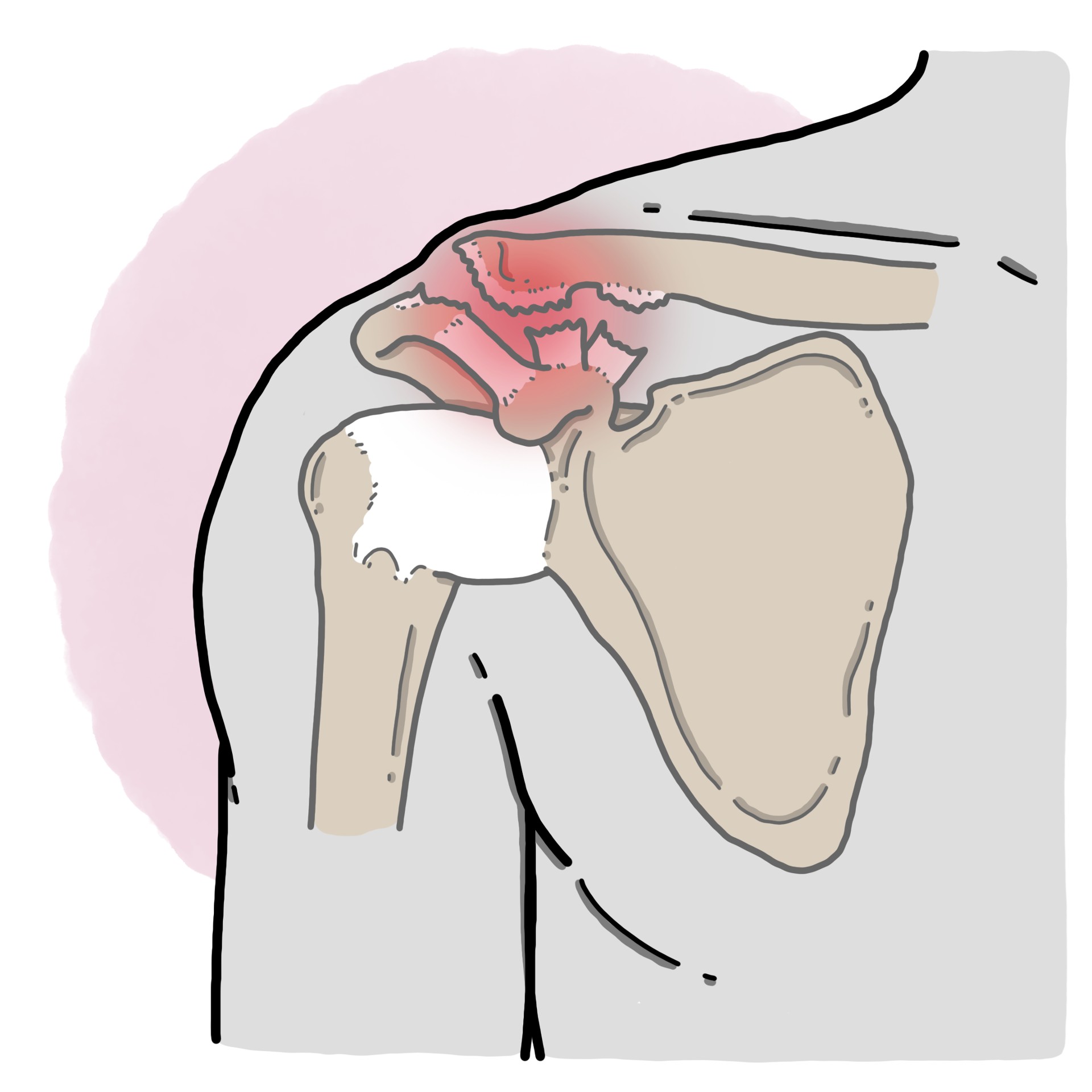 Acromioclavicular joint luxation