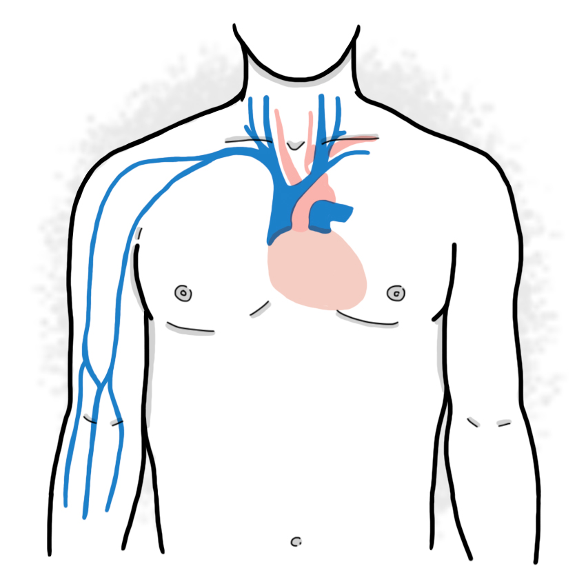Superior vena cava syndrome