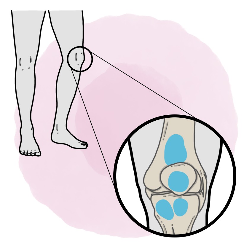 Knee bursitis