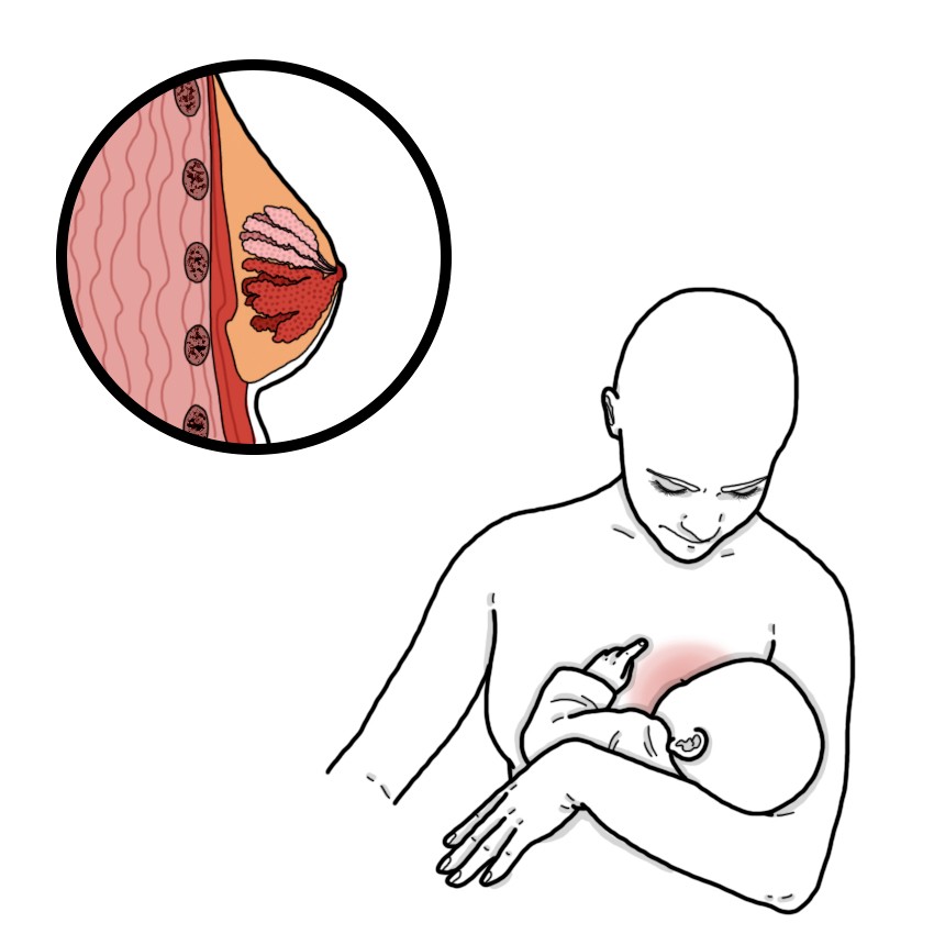 Breastfeeding mastitis - Puerperal mastitis