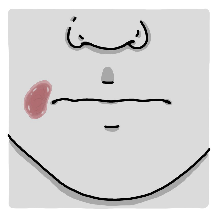Gomas sifilíticas