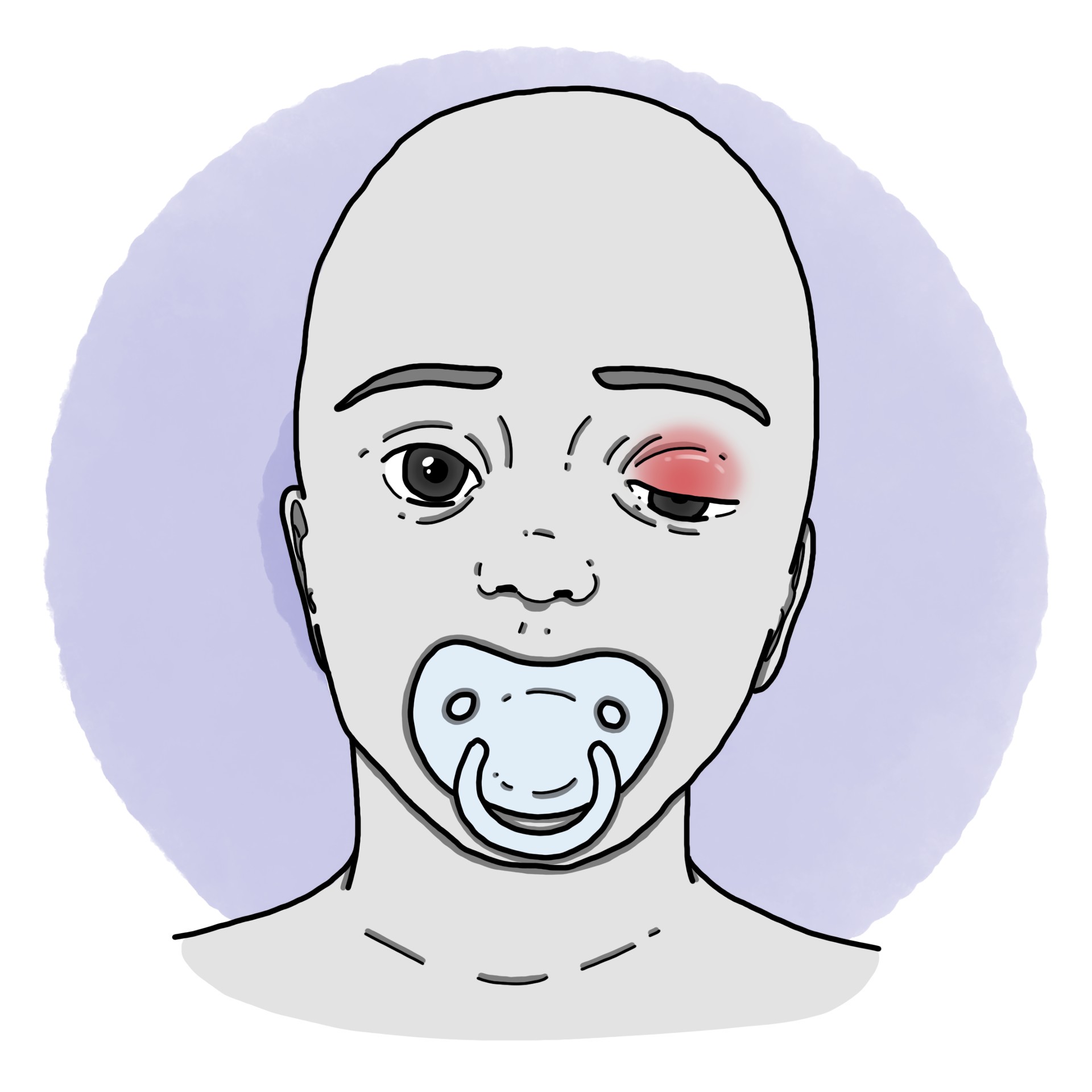 Orbital cellulitis (Paediatrics)