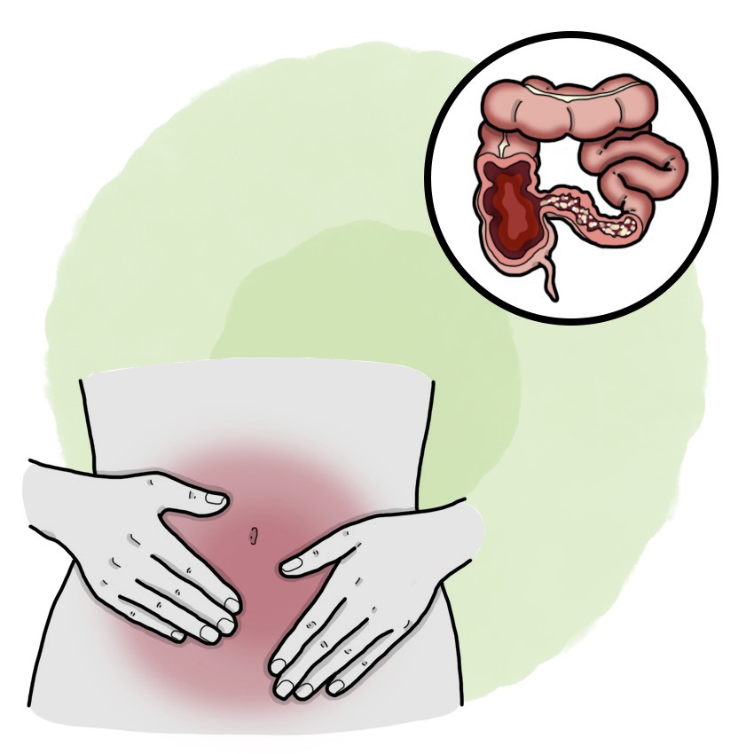 Crohn's disease - Inflammatory bowel disease
