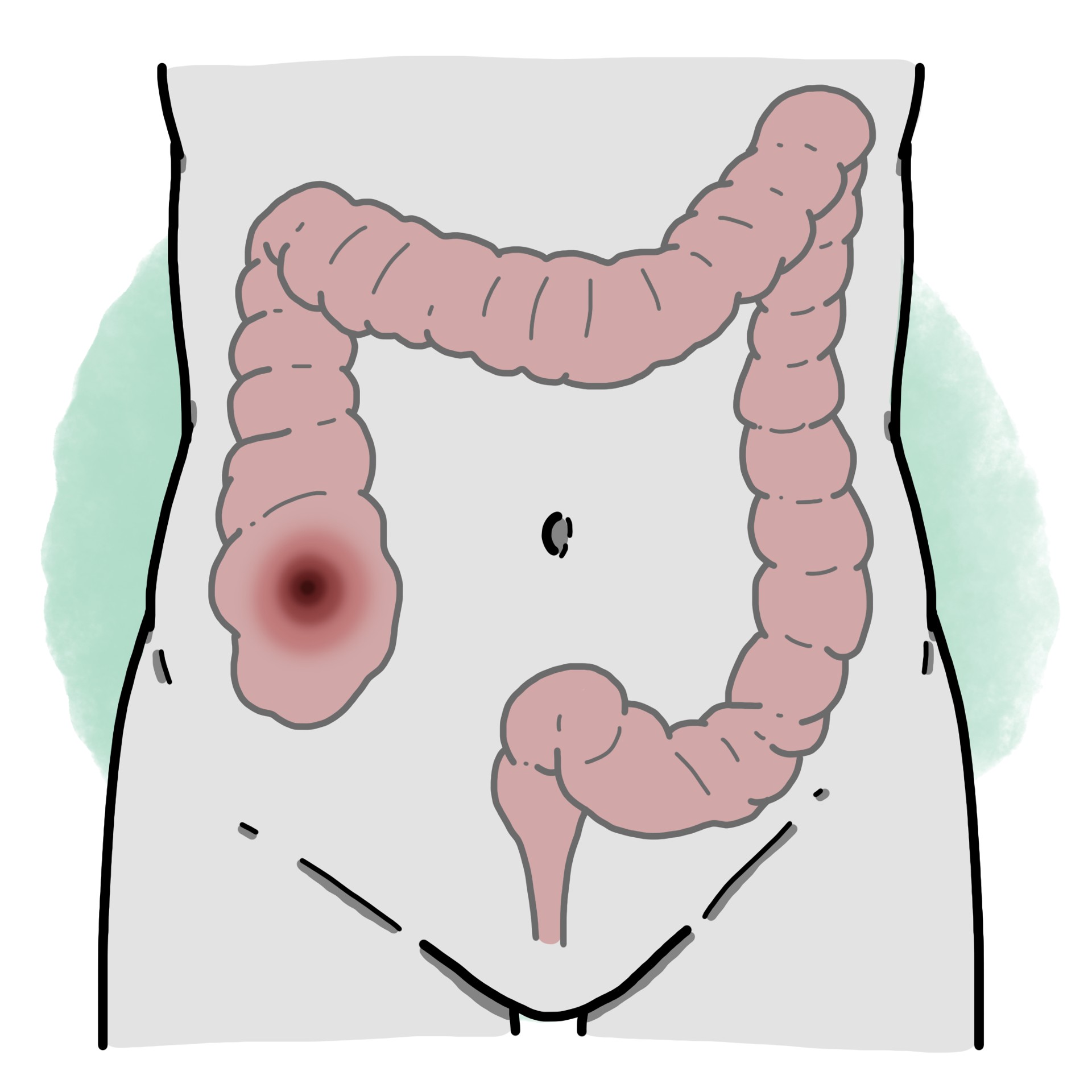Large intestine perforation