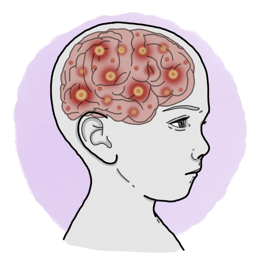 Simple partial epilepsy - Simple partial seizures (Paediatrics)