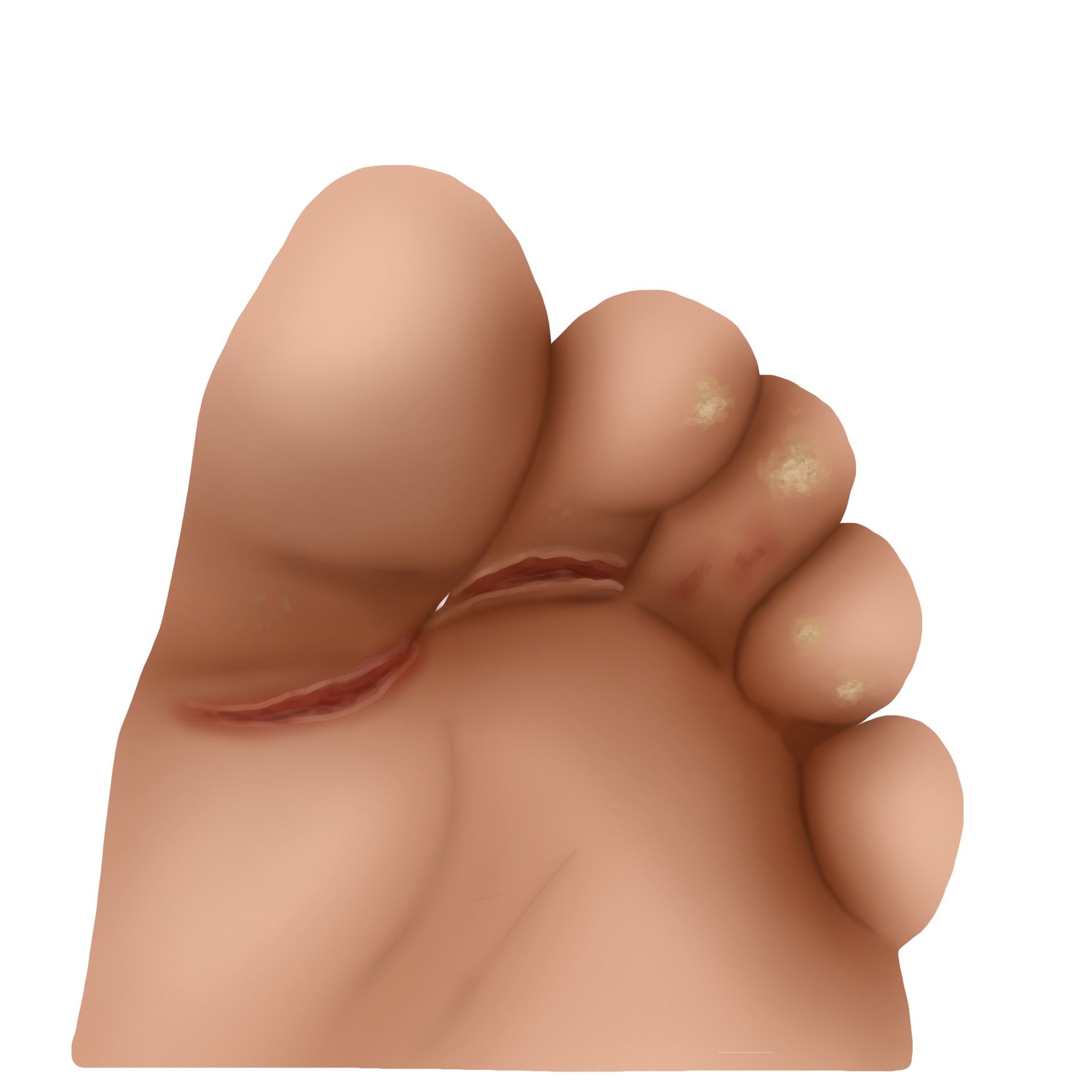 Athlete's foot - Tinea pedis