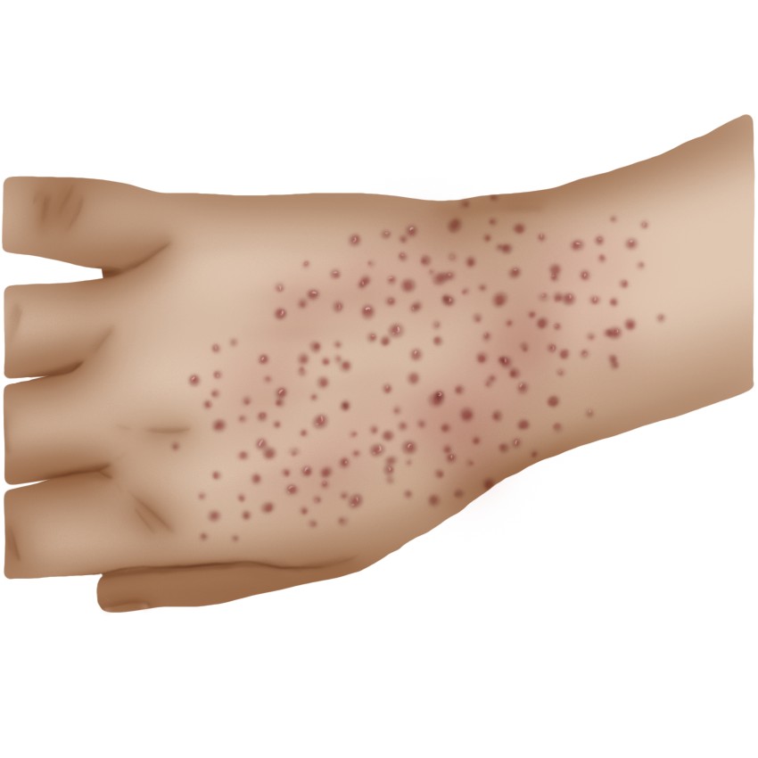 Lichen planus