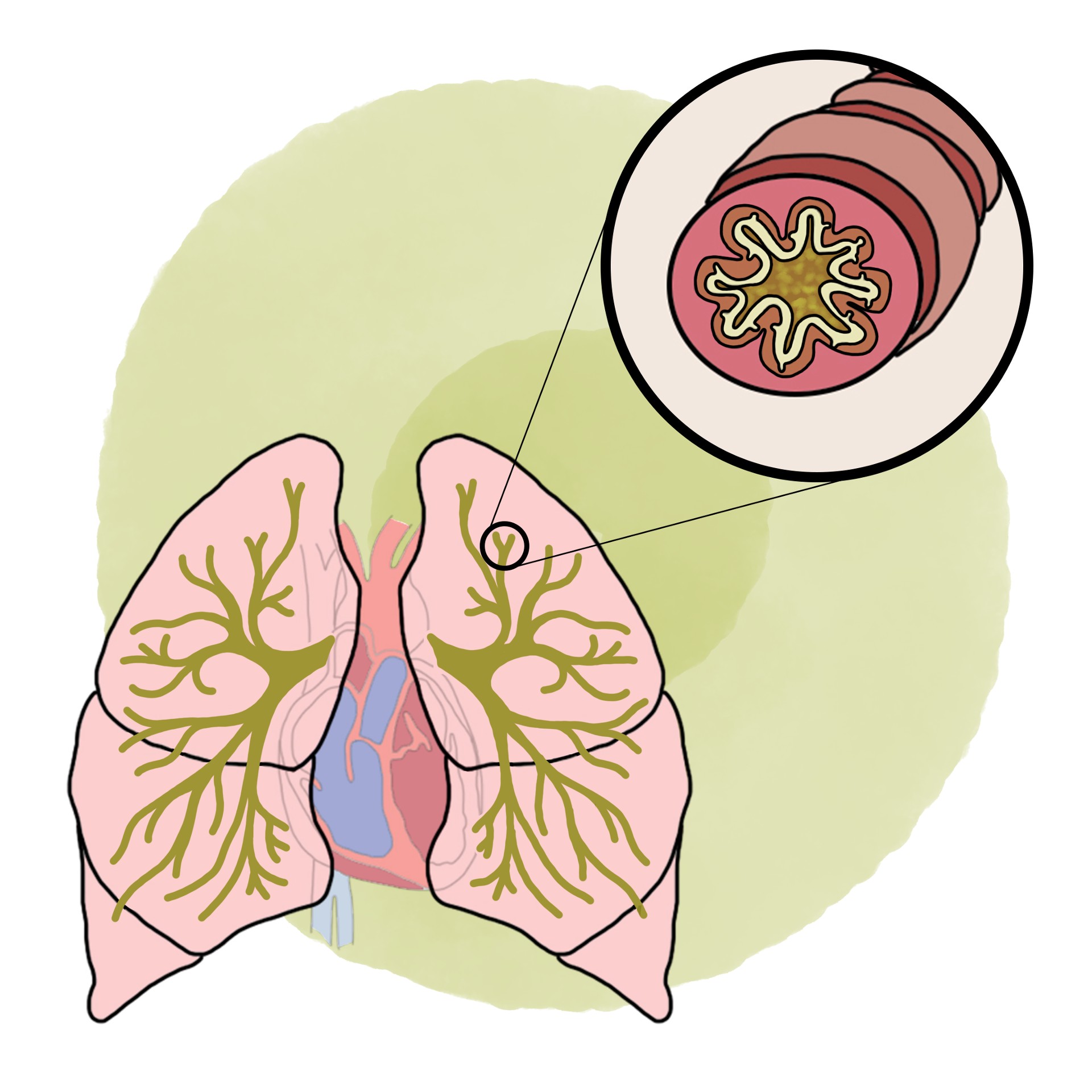 Bronchial hyperresponsiveness