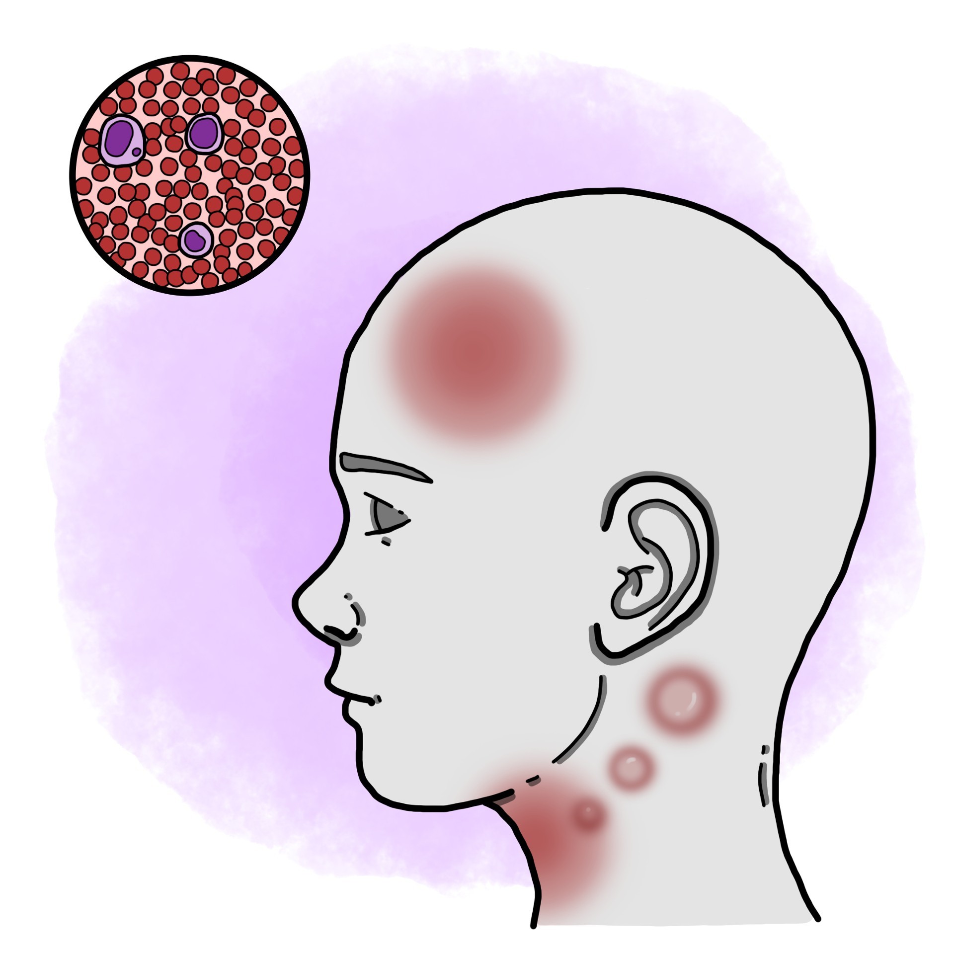 The kissing disease - Infectious mononucleosis