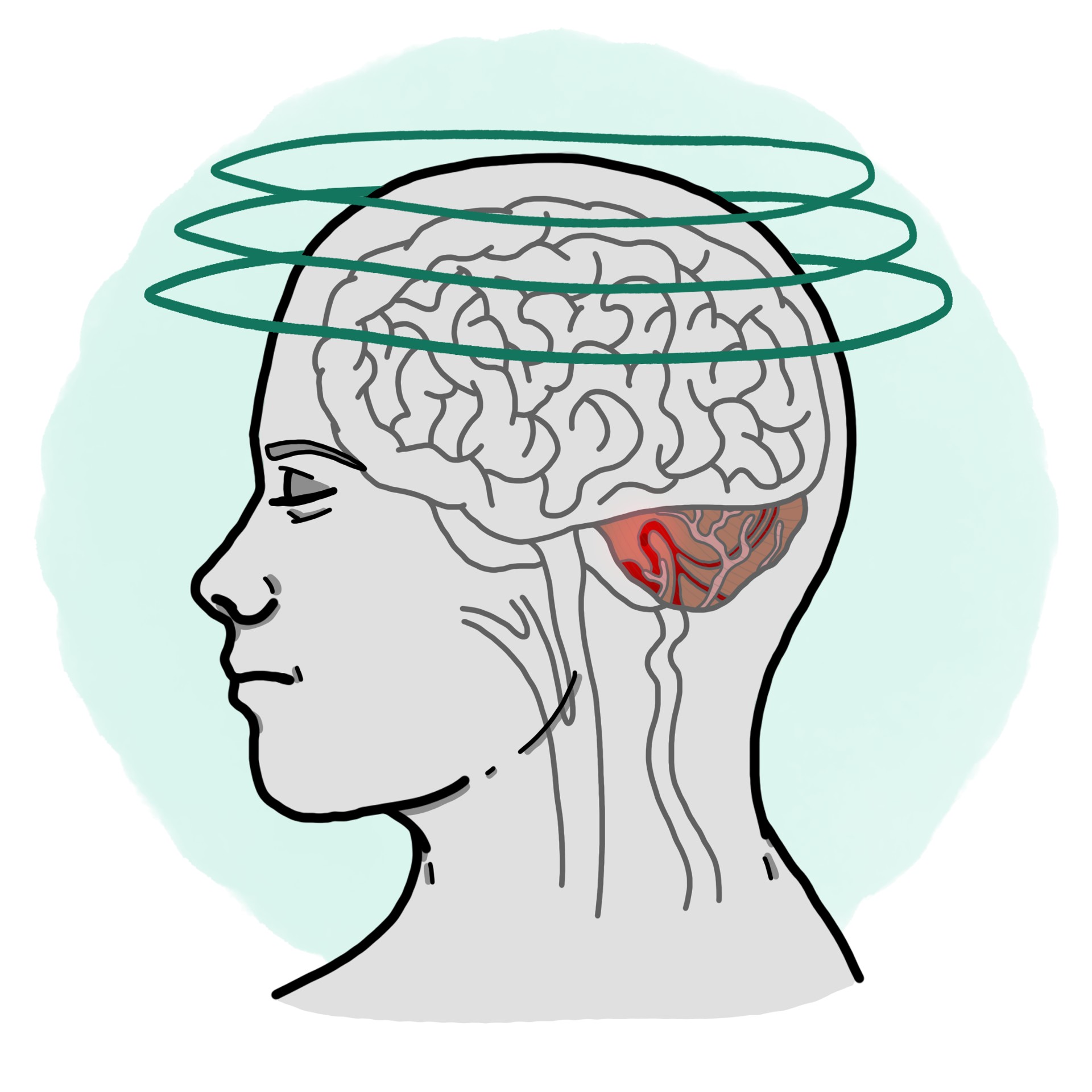 Central vertigo due to infarction of the posterior inferior cerebellar artery - Wallenberg syndrome