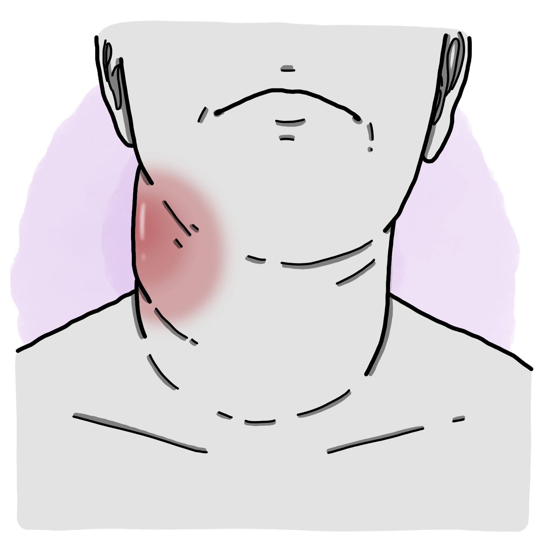 Adenophlegmon - Lymphadenitis (Paediatrics)