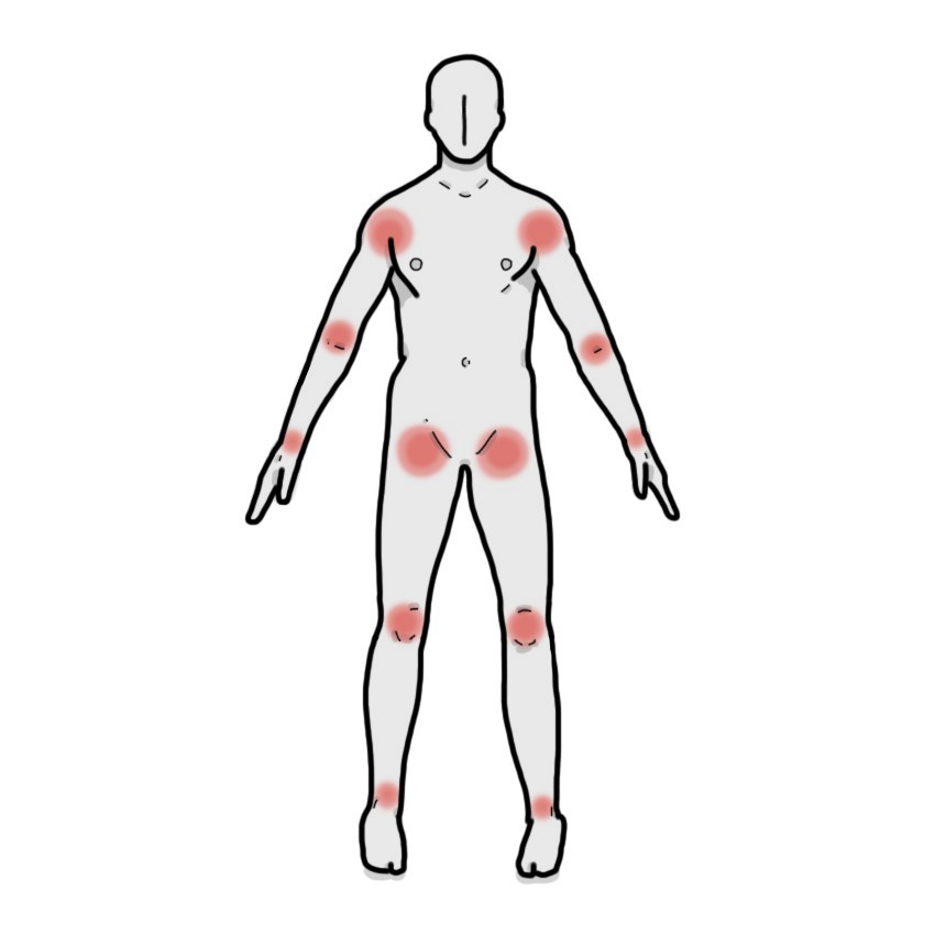 Artralgia