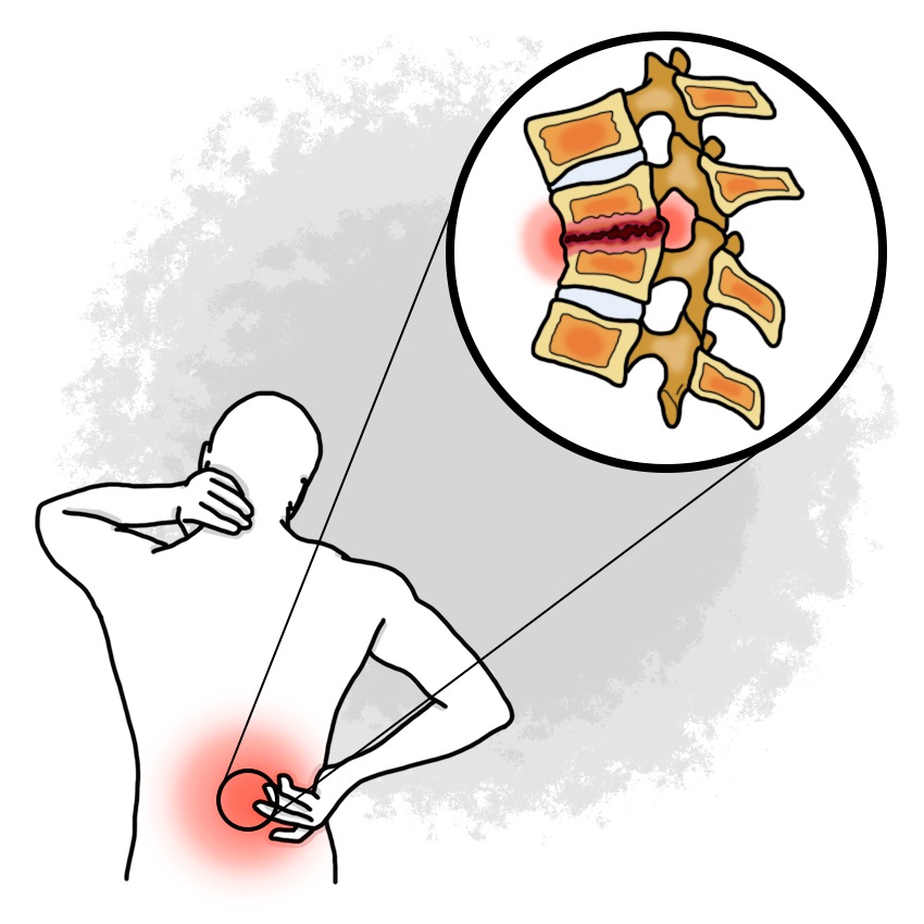 Spondylodiscitis - Vertebral osteomyelitis