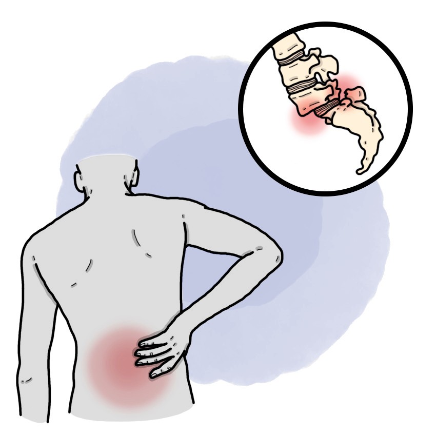 Shifting of the vertebrae - Spondylolisthesis