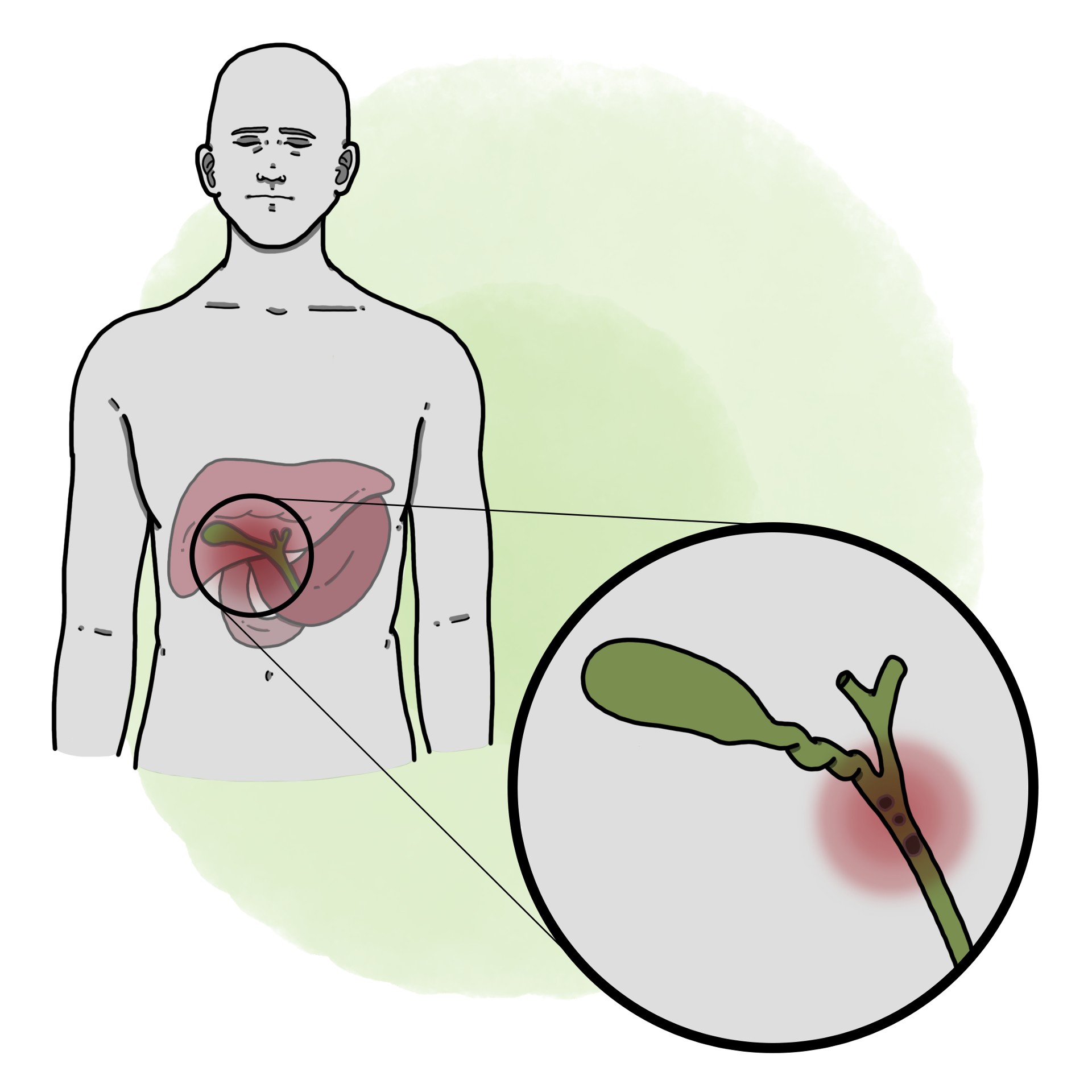 Cholangitis - Biliary sepsis