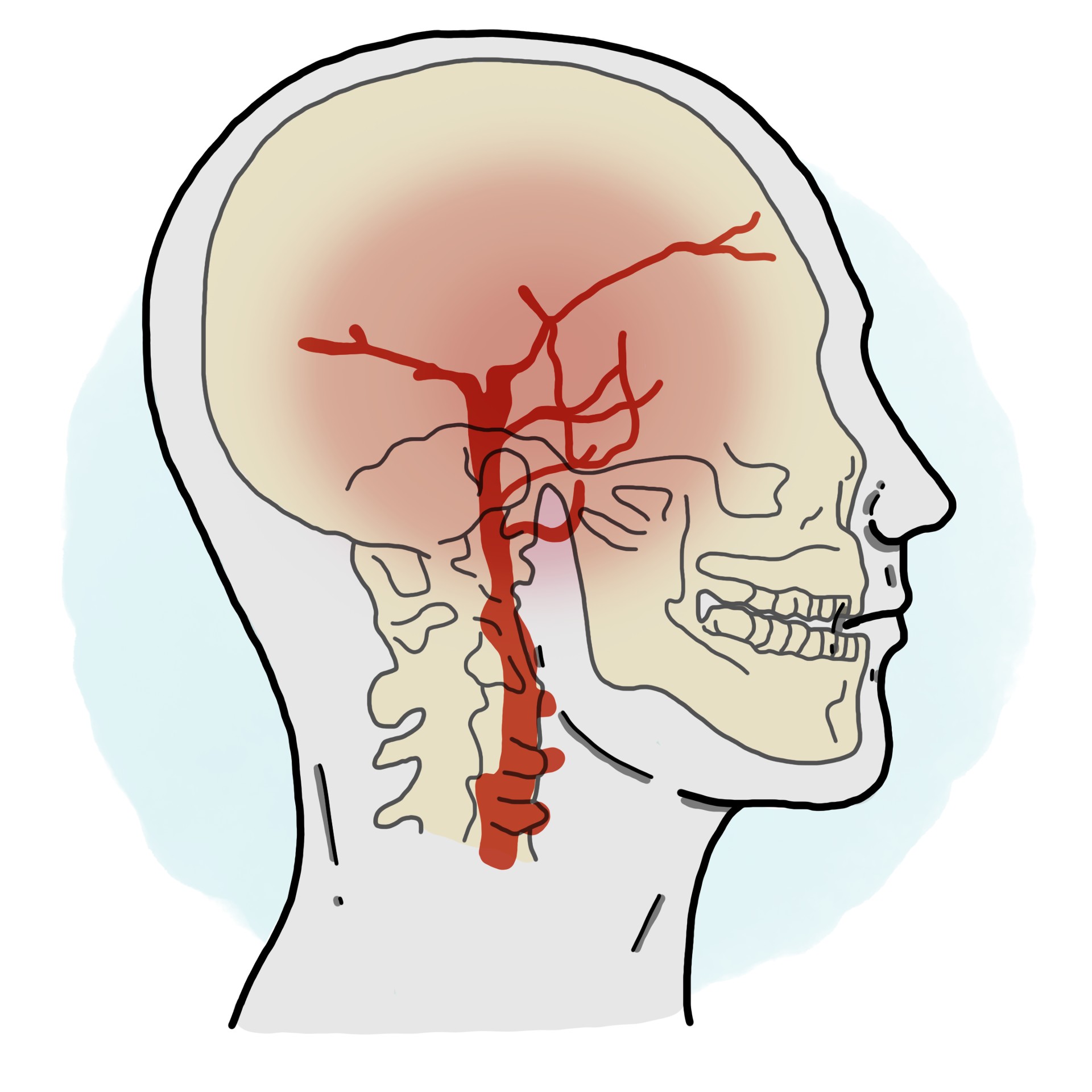 Arteritis of the temporal artery or Horton's disease