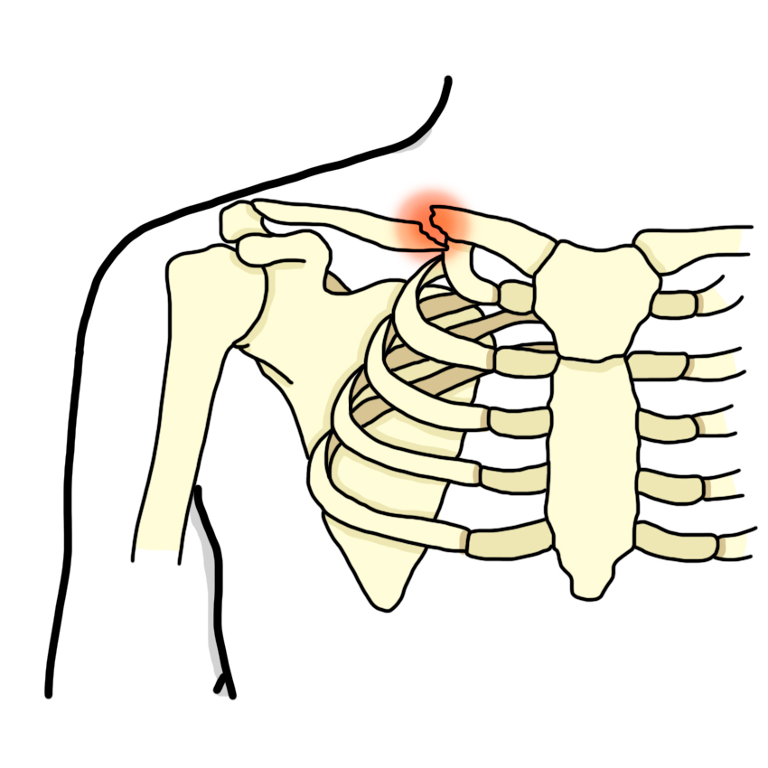 Collarbone fracture
