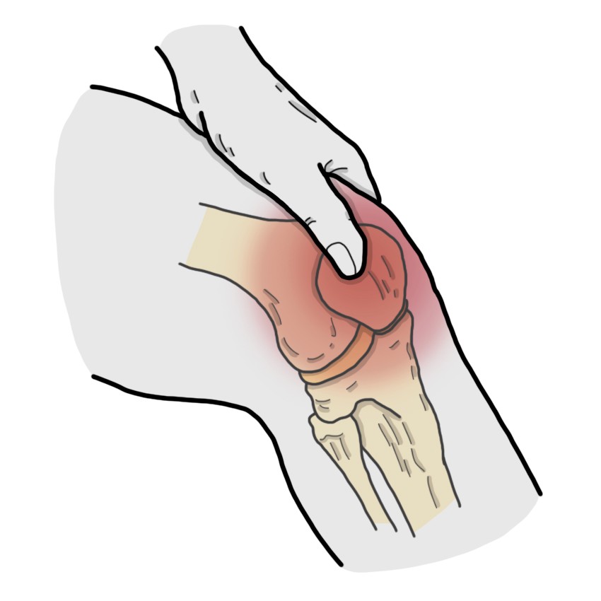 La douleur au genou augmente en appuyant sur la rotule