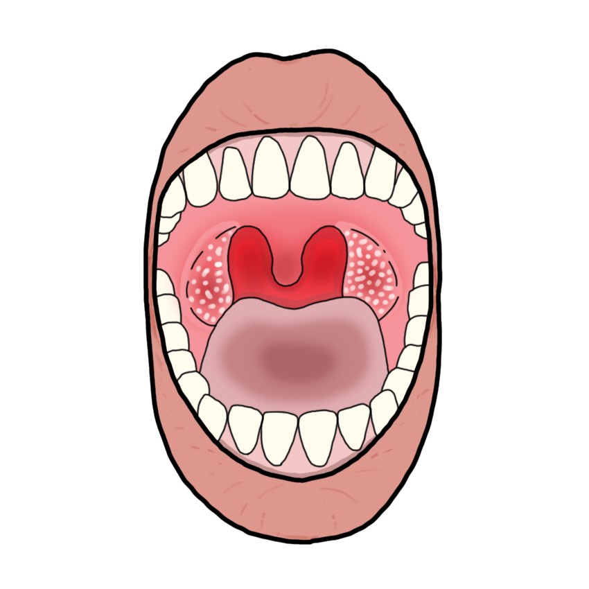 Bacterial tonsillopharyngitis (Paediatrics)