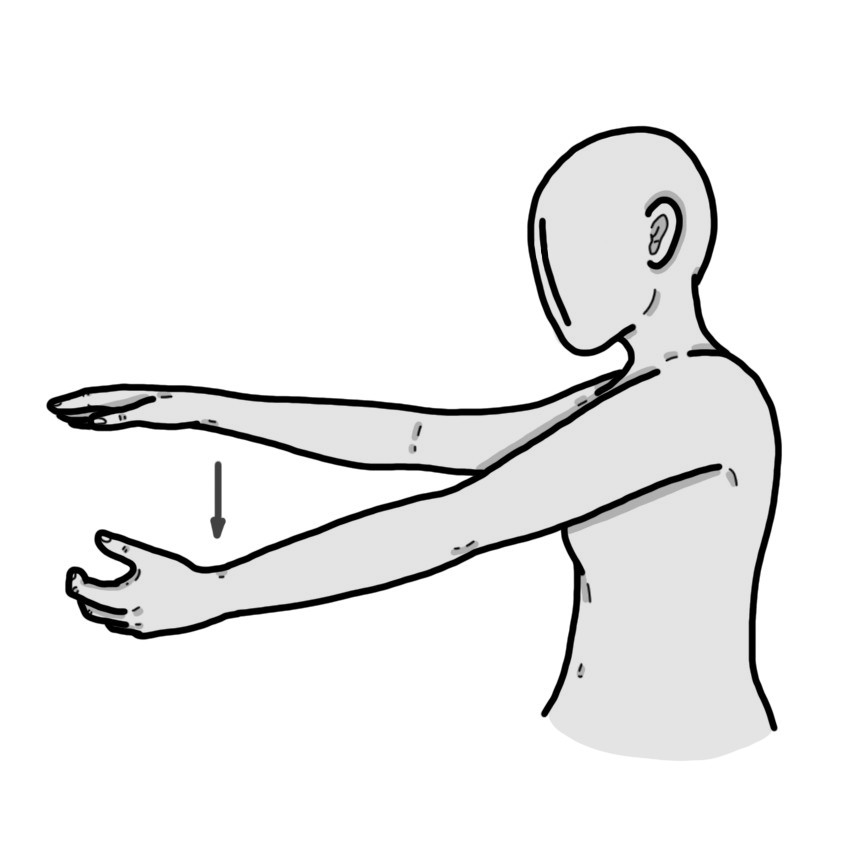 Hemiparesis/hemiplegia