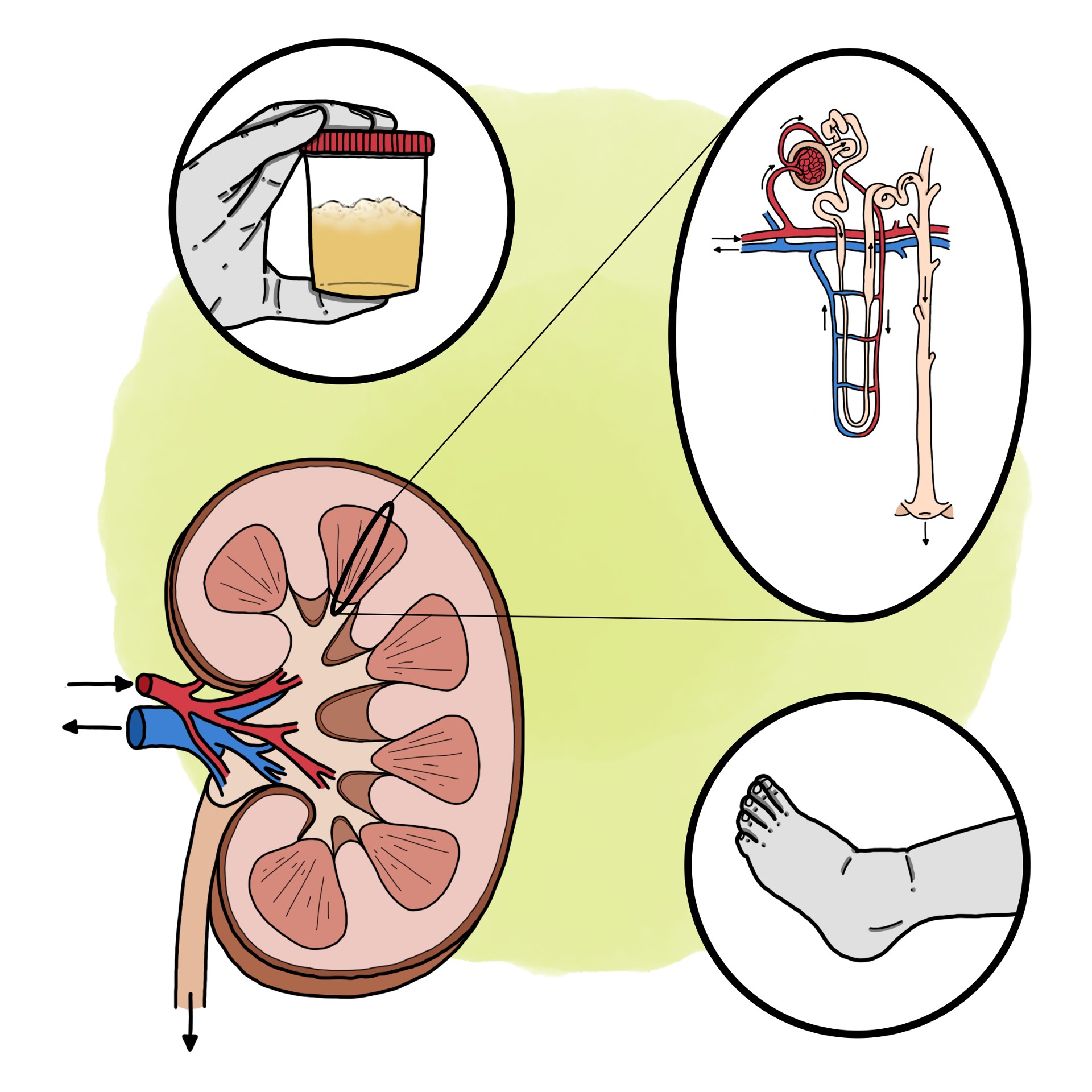 Nephrotic syndrome (Paediatrics)