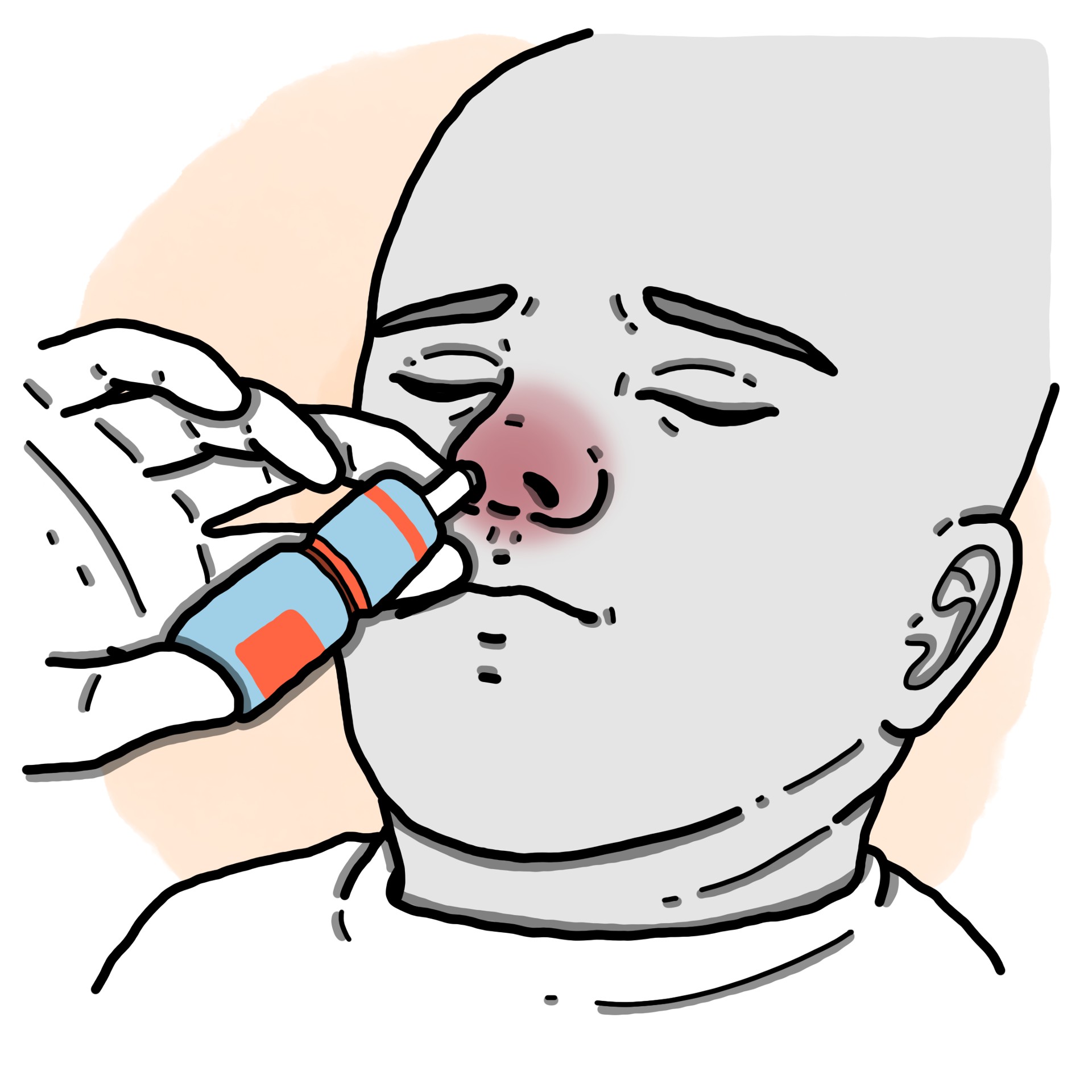 Allergic rhinitis - Hay fever