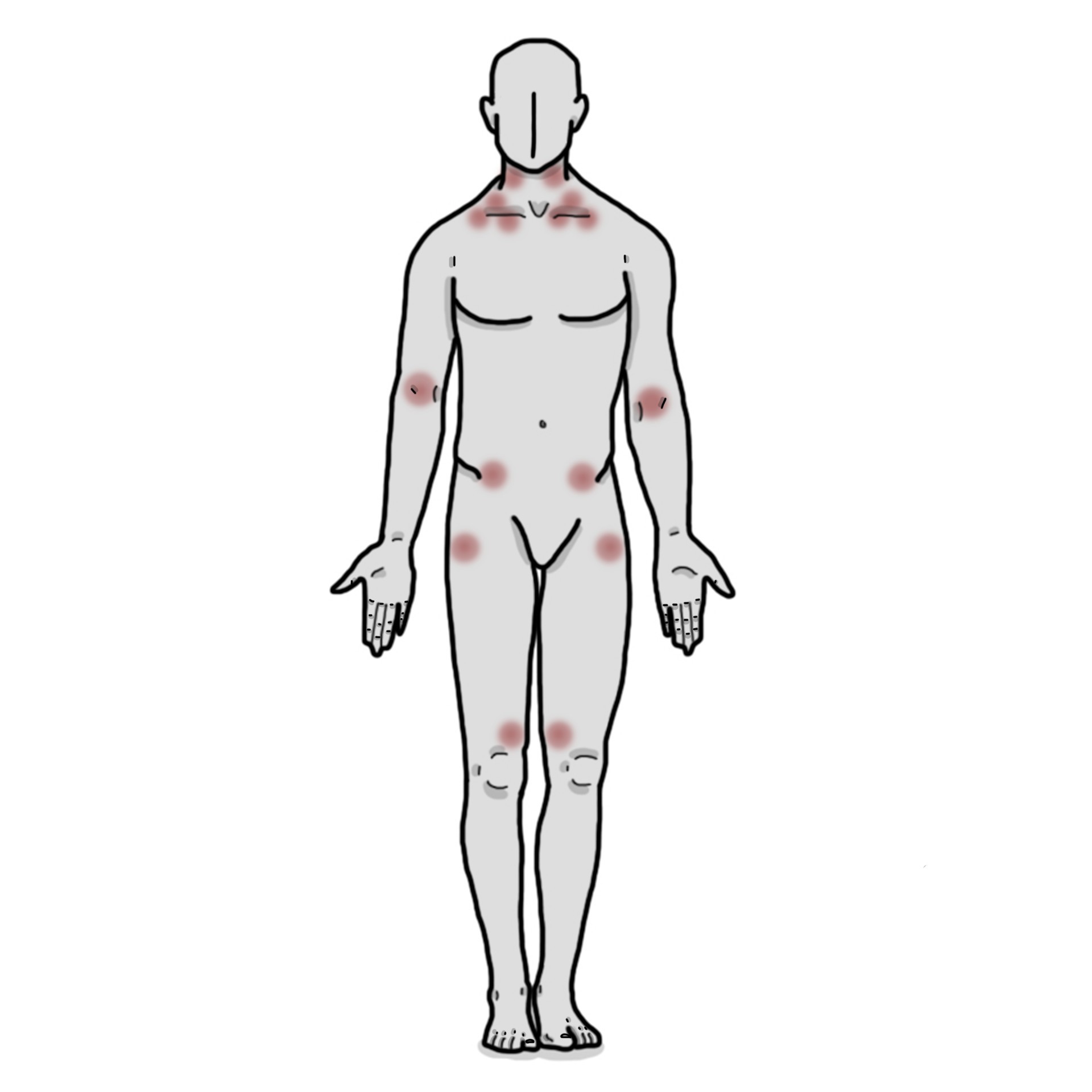 Dolor muscular generalitzat