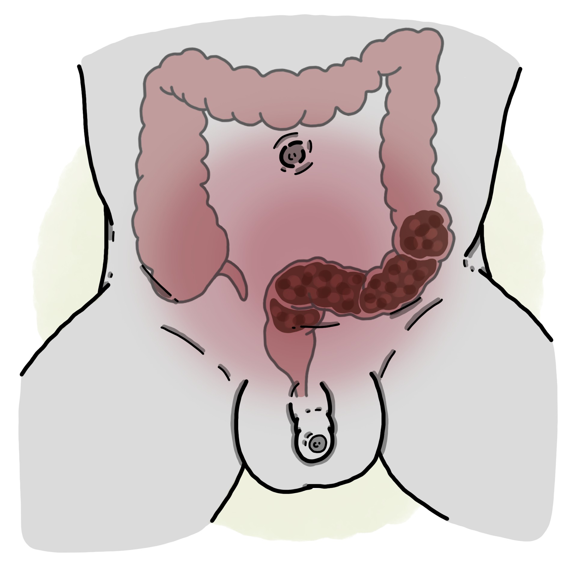 Uncomplicated constipation (Paediatrics)