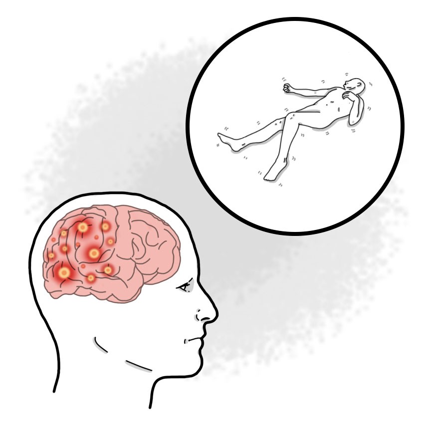 Complex partial epilepsy - Complex partial seizures
