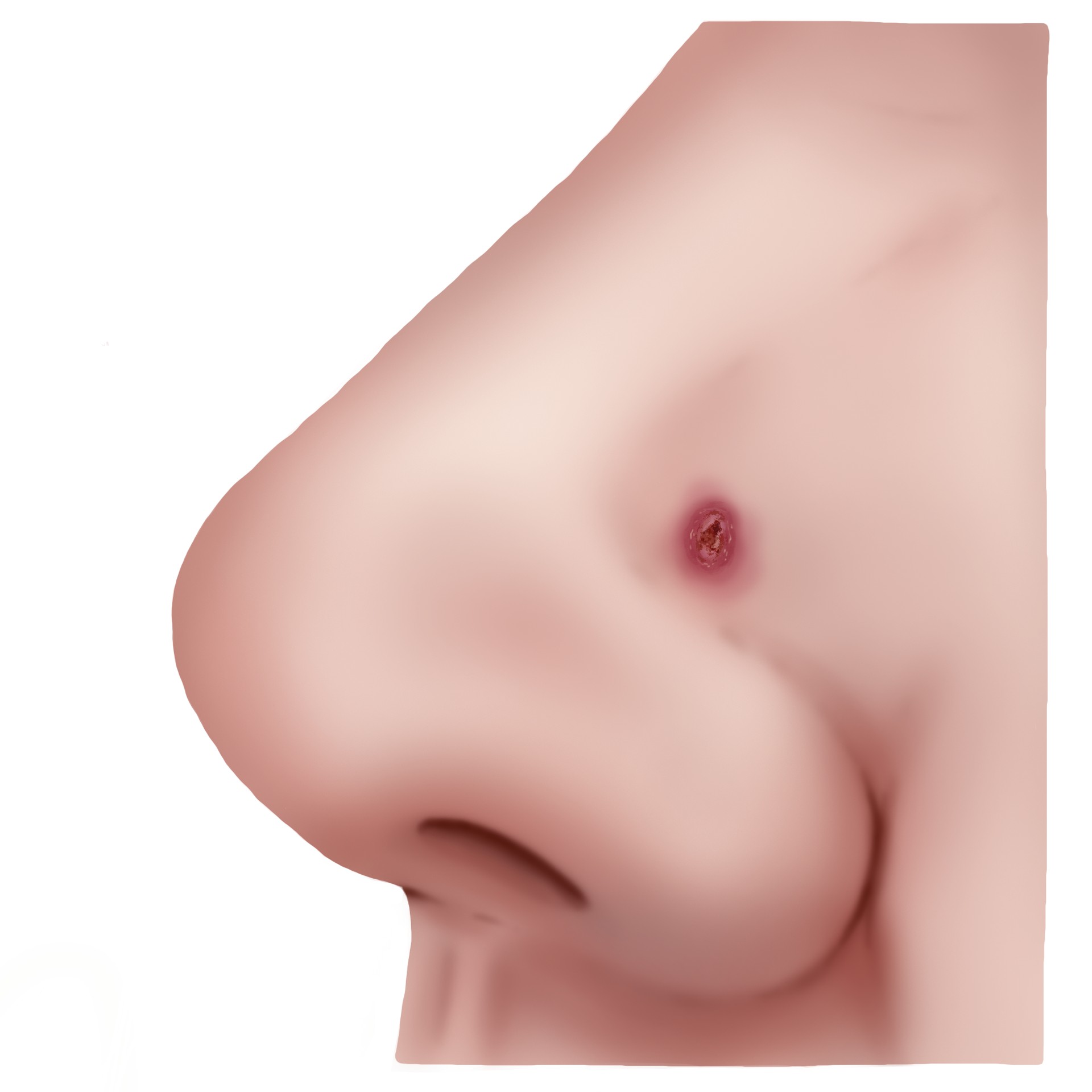 Squamous cell carcinoma