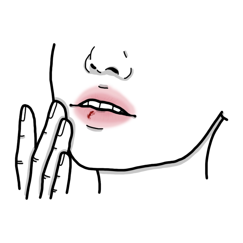 Lip wound