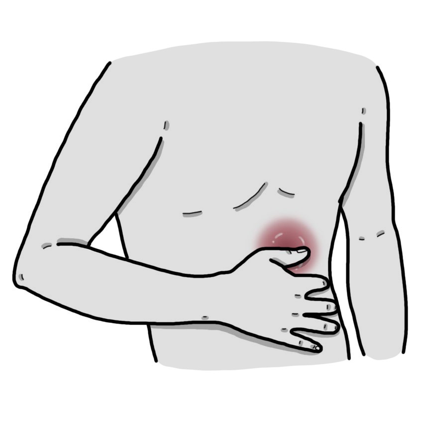 Palpable mass on the abdomen