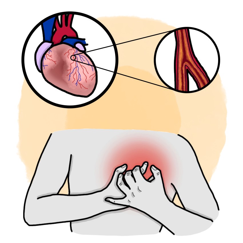 Chronic coronary disease - Chronic ischaemic cardiopathy
