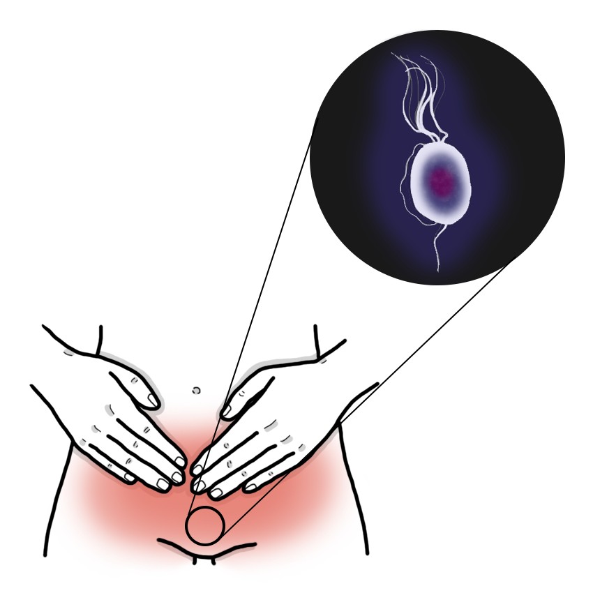Trichomoniasis