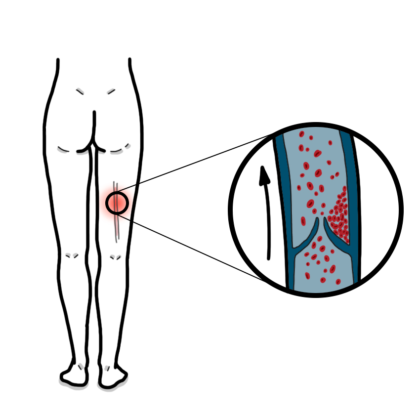 Deep-vein thrombosis - DVT