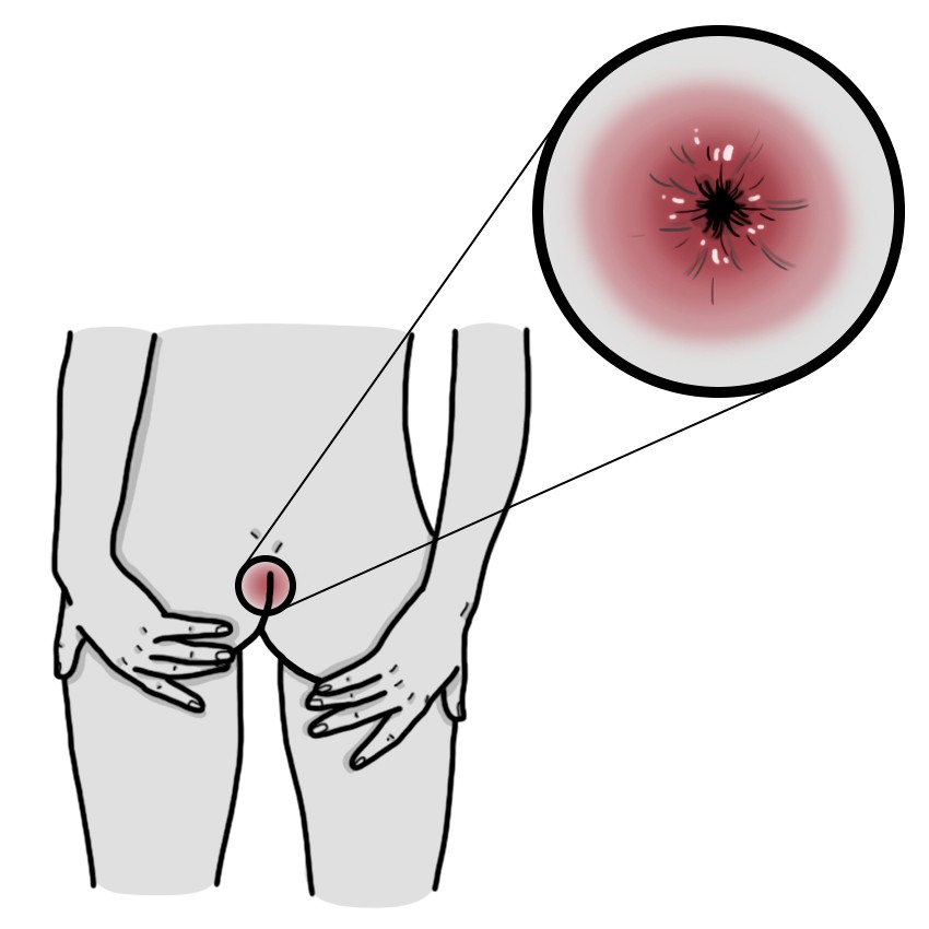 Swollen and reddened anus