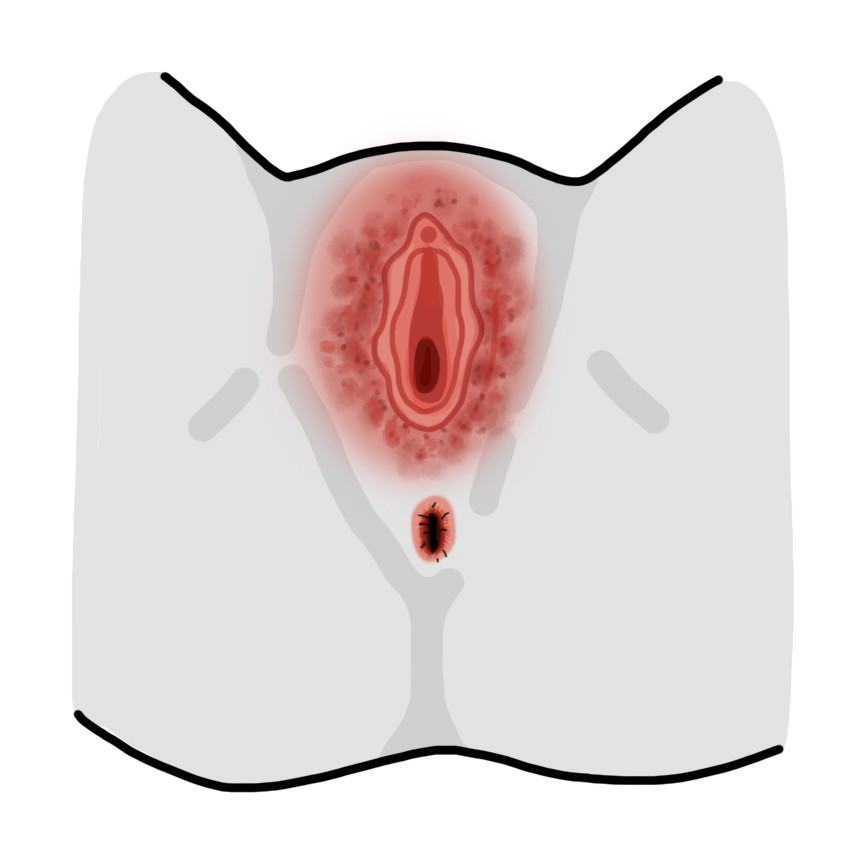 Εξάνθημα στα γεννητικά όργανα