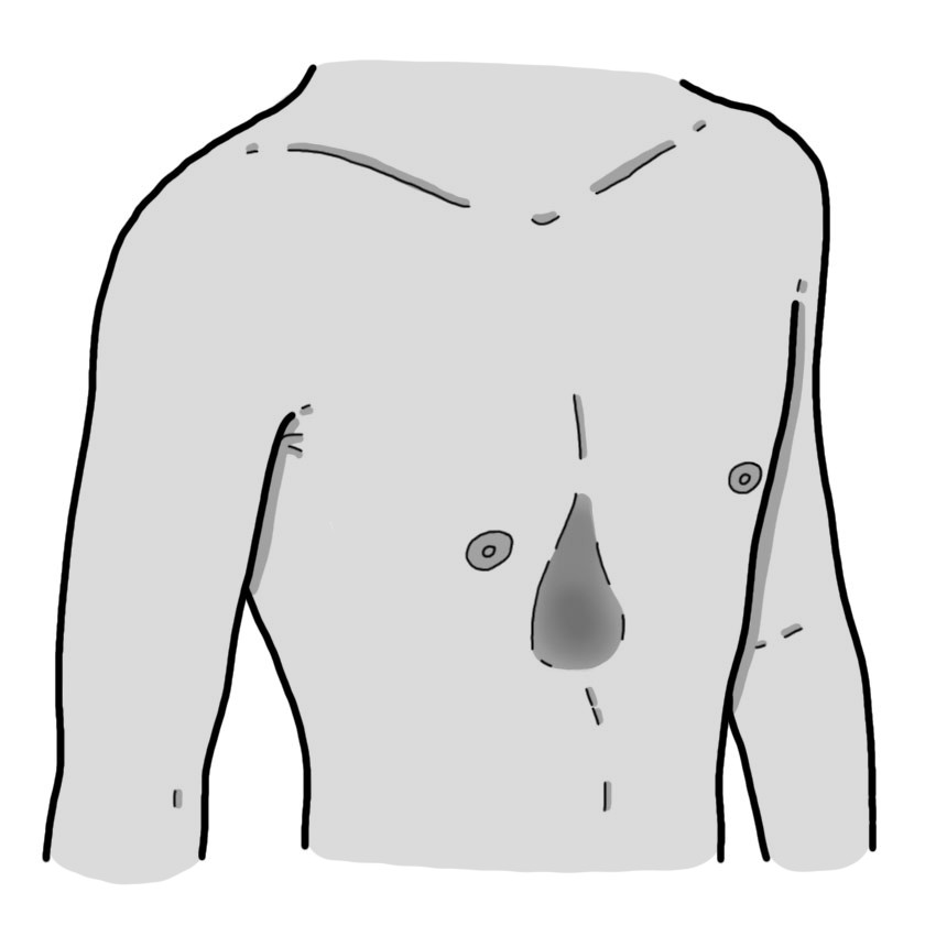 Pectus excavatum