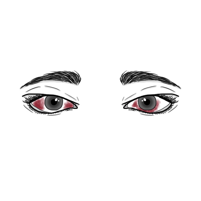 Sub-conjunctival haemorrhage - Hyposphagma