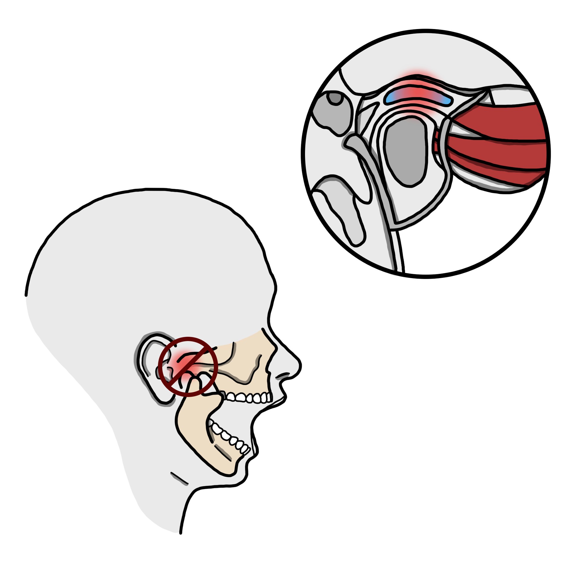 Bloqueo de la articulación temporomandibular