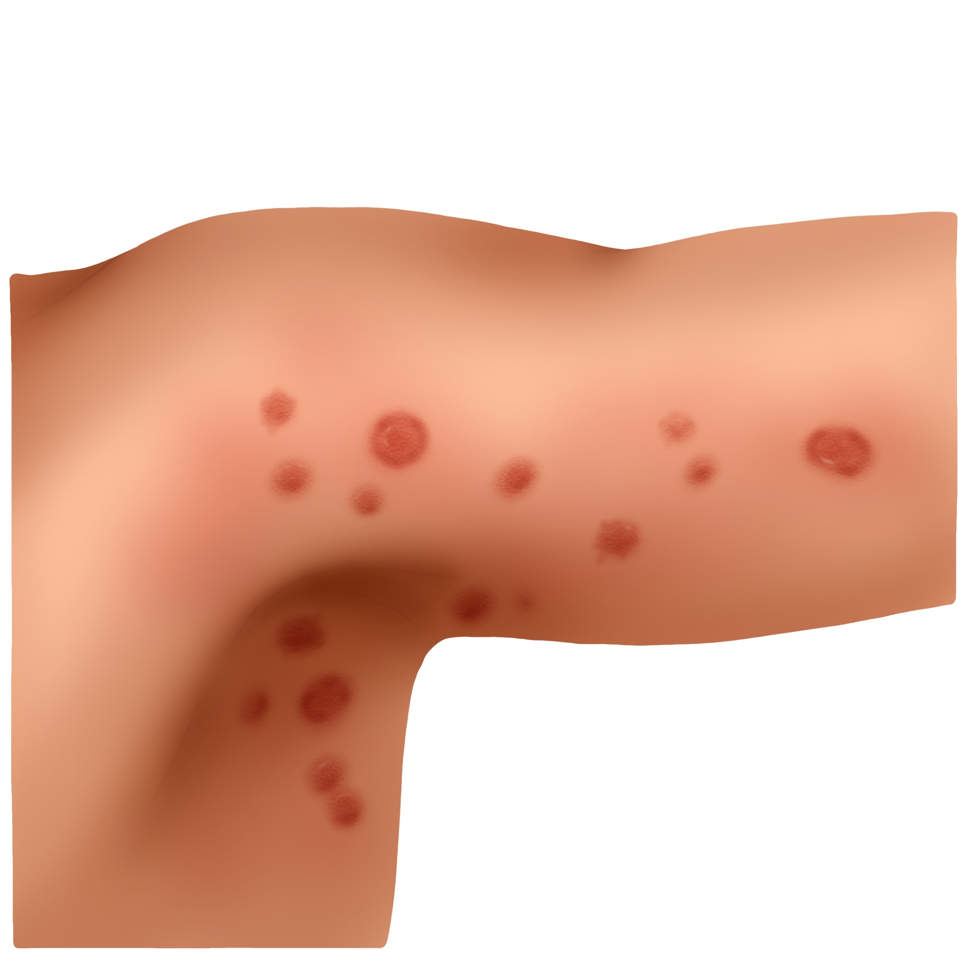 Pityriasis rosea Gibert (Paediatrics)
