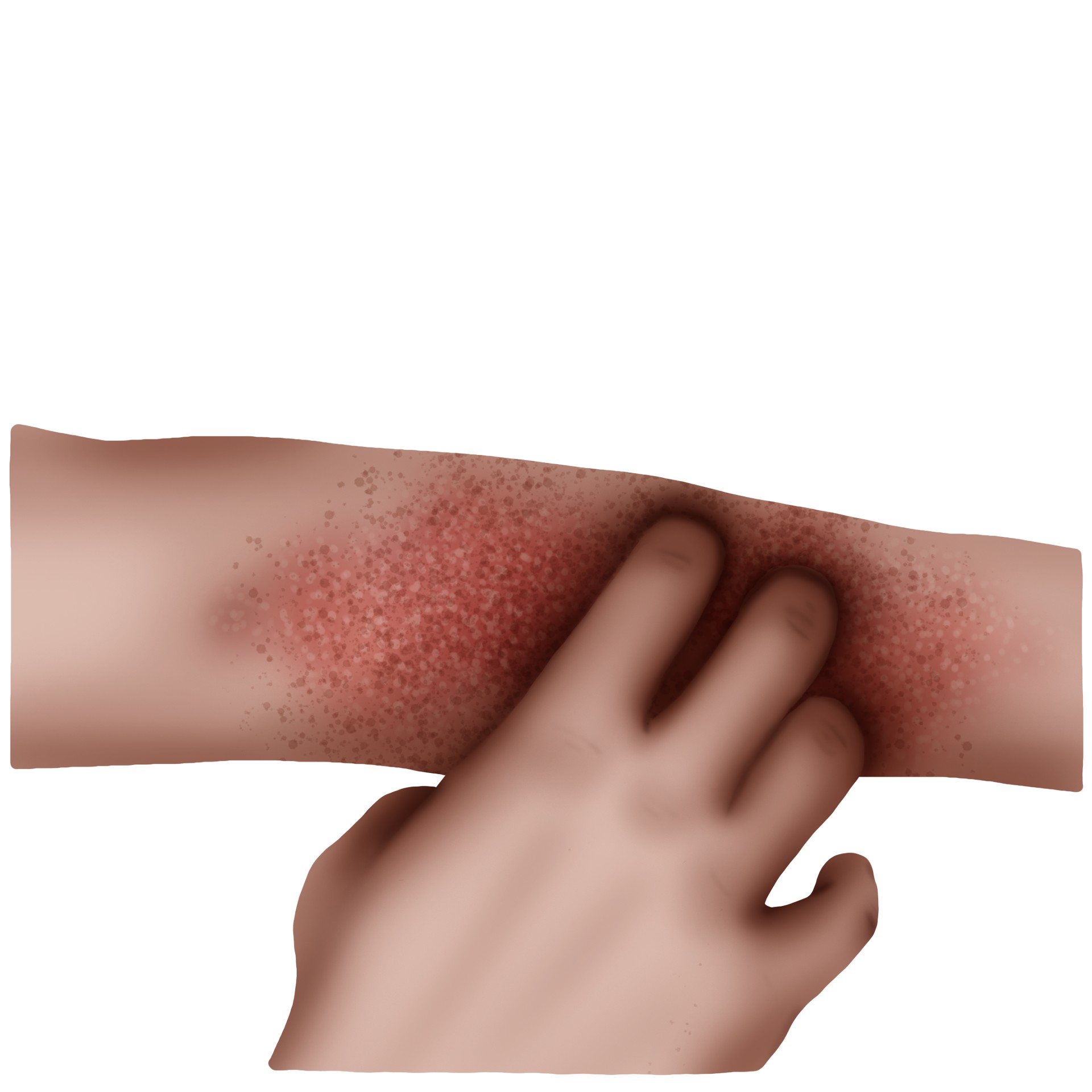 Drug-induced toxicoderma