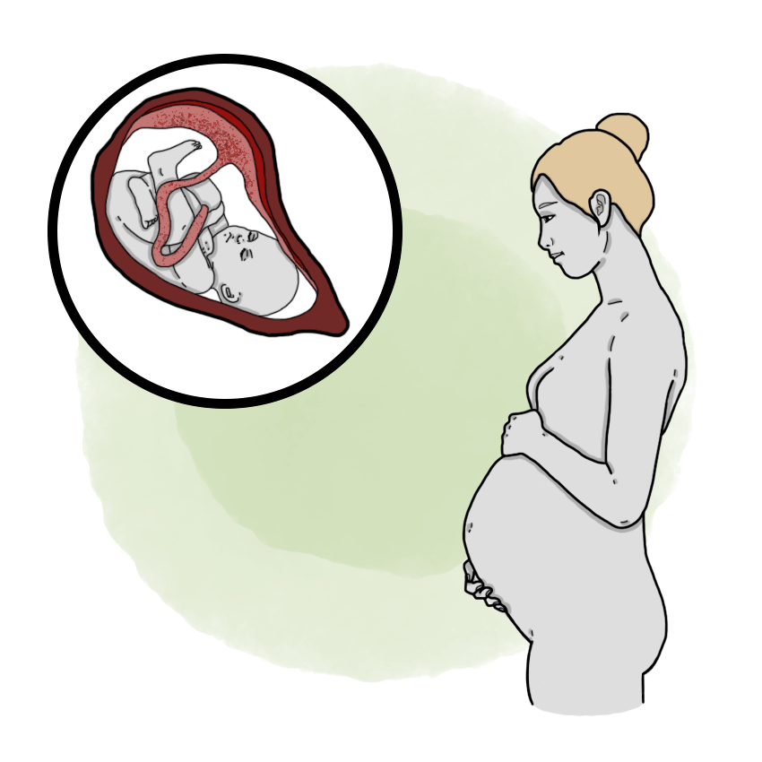 Premature detachment of normally posed placenta - Placental abruption