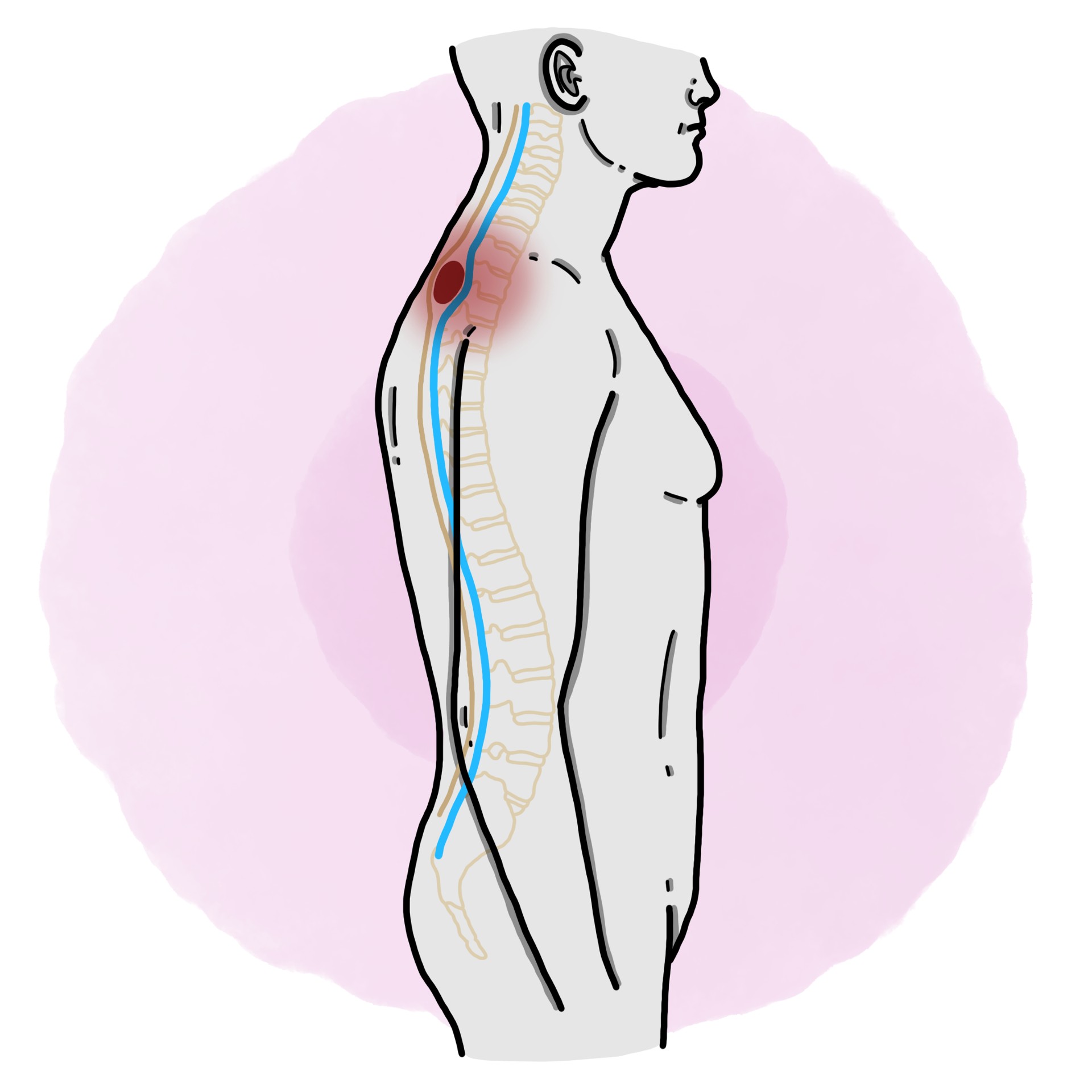 Spinal cord compression due to cancer