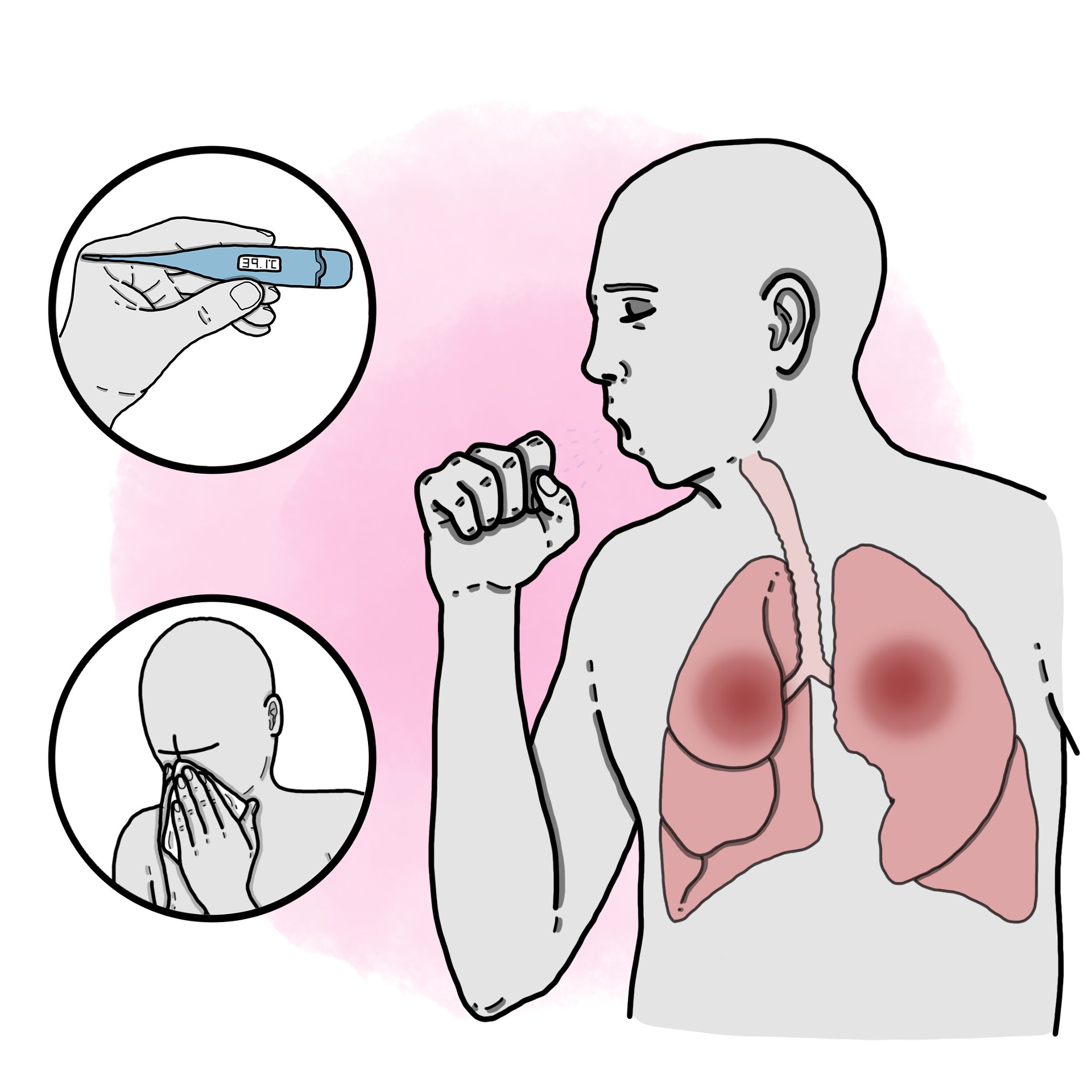 Typical pneumonia - Community-acquired pneumonia