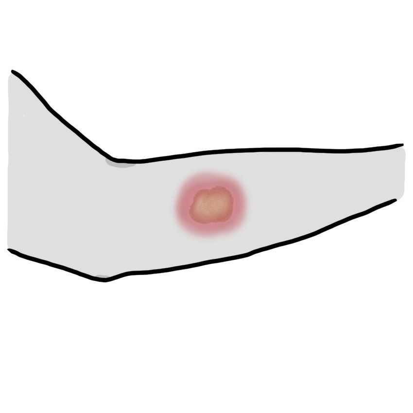 Painful cutaneous patch