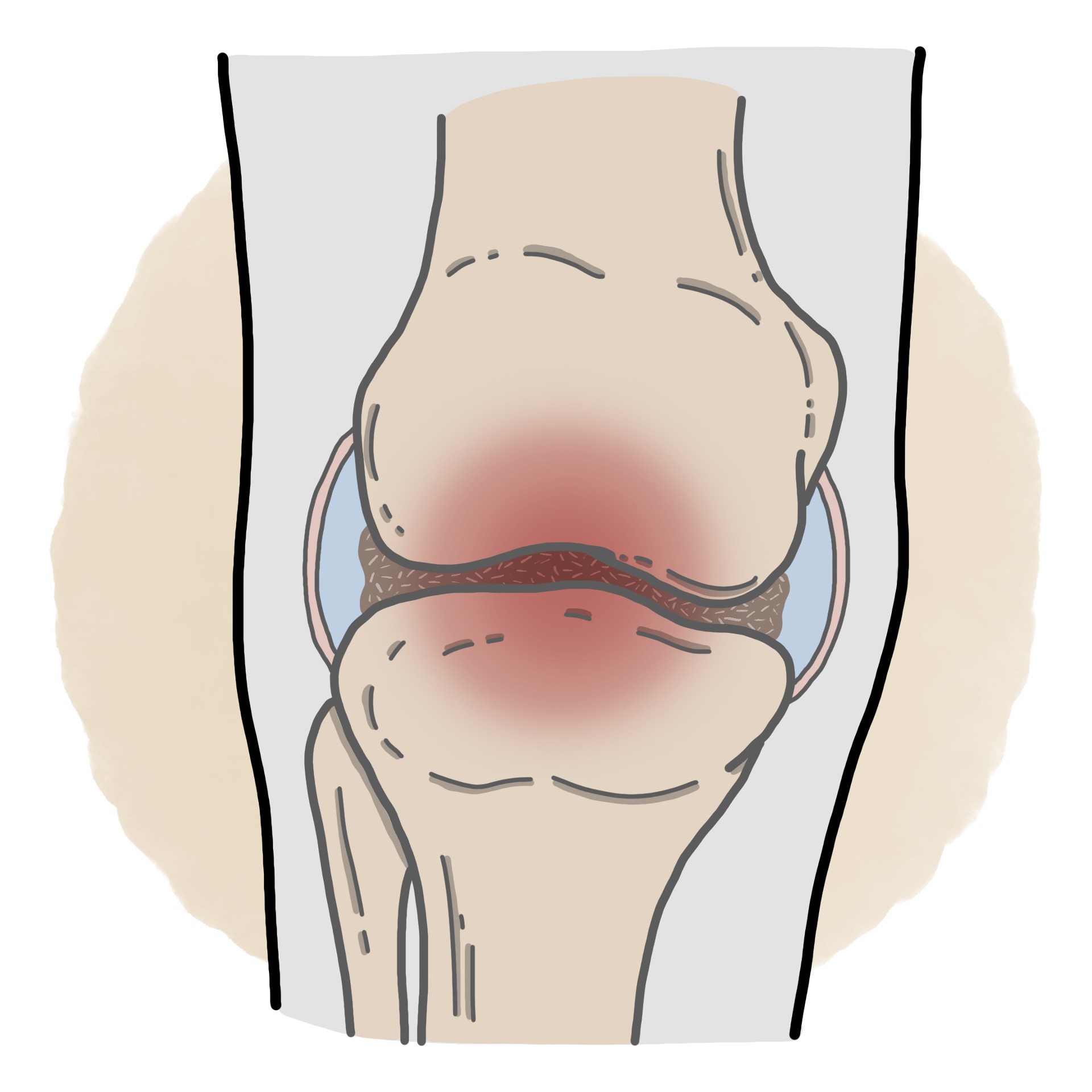 Pseudogout - Chondrocalcinosis
